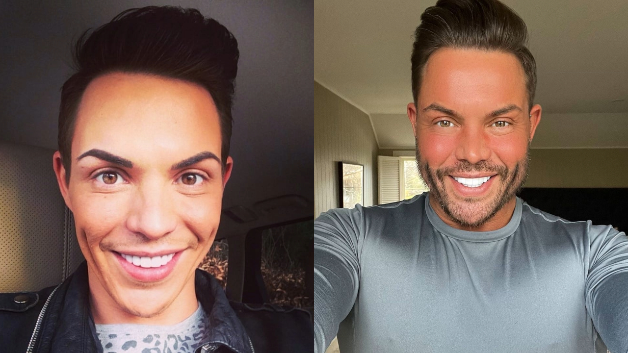 The Unfiltered Story of Bobby Norris and Plastic Surgery weightandskin.com